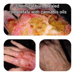 Chemical burn healed completely with cannabis oil